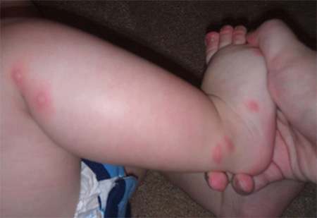 Piqûres de punaises de lit sur la jambe d'un enfant