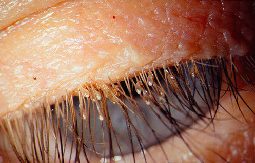 Les lentes de poux du pubis sur les cils sont clairement visibles