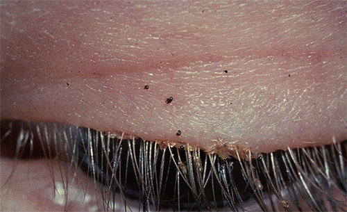 Une autre photo de poux pubiens et de lentes sur les cils humains