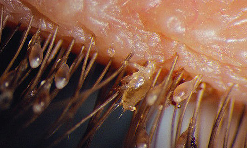 Les poux du pubis peuvent également vivre sur les cils et les sourcils.
