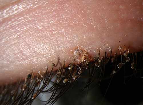 Les poux et les lentes sont clairement visibles entre les cils