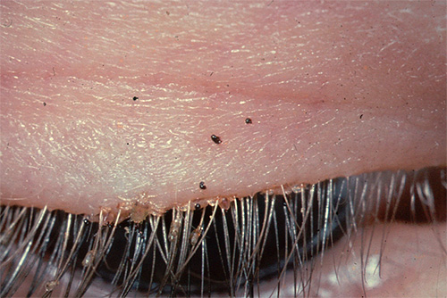 Une autre photo où l'on peut voir des poux et des lentes sur les cils d'une personne