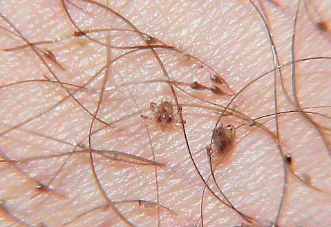 Poux du pubis sur les cheveux humains