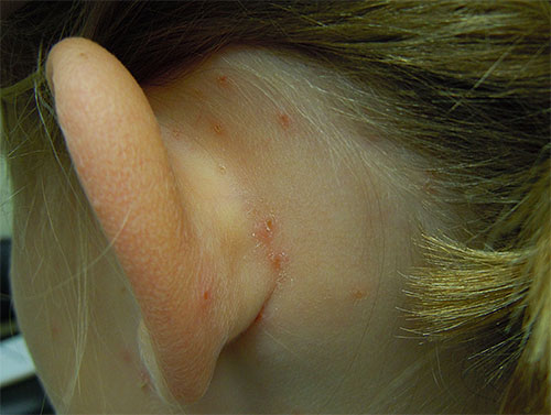 Il est plus facile de remarquer de telles morsures sur le cou et derrière les oreilles de l'enfant.