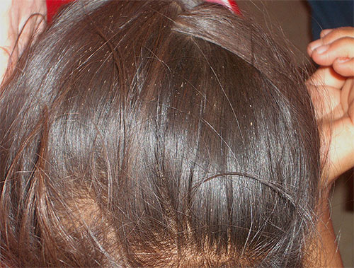 Les lentes des cheveux ressemblent à des grappes de points blancs
