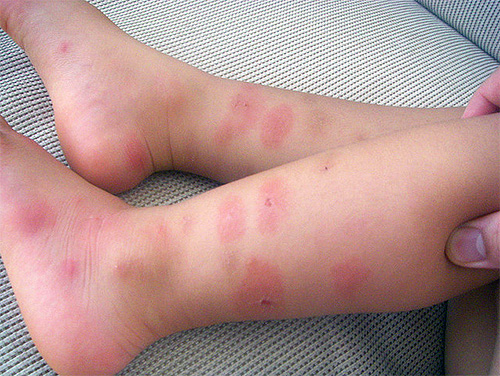 Il est difficile pour les enfants de résister au grattage des piqûres, ce qui signifie que ces plaies sont une porte ouverte aux infections.