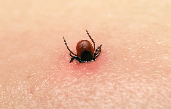 Le sfumature del pronto soccorso per una puntura di zecca...
