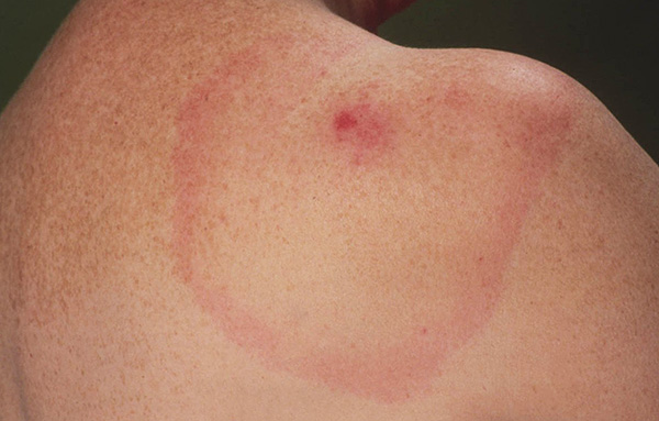 Anche se non ci sono sintomi evidenti della malattia, le condizioni della vittima devono essere attentamente monitorate per almeno 2 mesi dal momento della puntura della zecca.