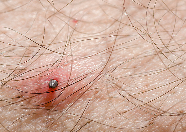 Più a lungo il parassita continua a succhiare sangue, più saliva infetta inietta nella ferita.