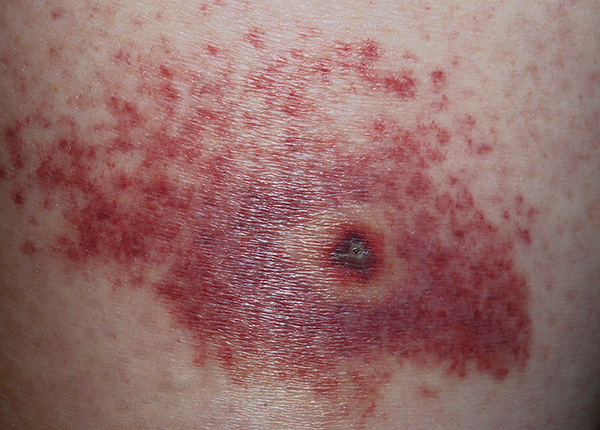 Il trattamento antisettico del sito del morso non protegge dall'encefalite da zecche o dalla borreliosi, ma riduce il rischio di infezione secondaria.