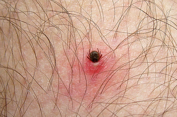 Quando si fornisce assistenza di emergenza a una persona che è stata morsa, è importante non commettere errori per non aggravare la situazione.