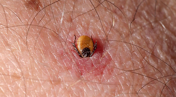 Vediamo cosa fare se una persona viene morsa da una zecca...