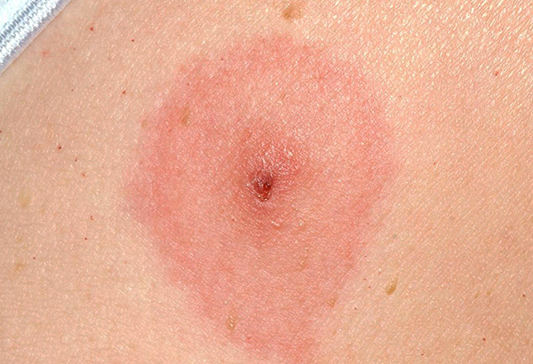 La ferita dopo il morso deve essere disinfettata.