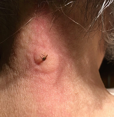 In alcuni casi, una grave reazione allergica si sviluppa su una puntura di zecca.
