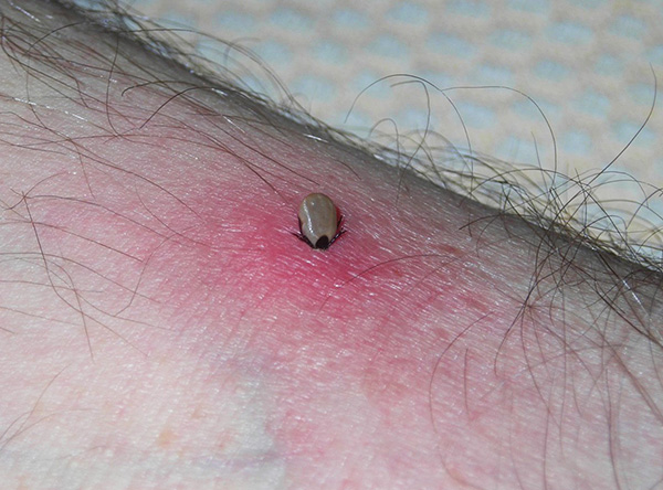 Più la zecca attaccata è sul corpo, più saliva infetta viene iniettata sotto la pelle.