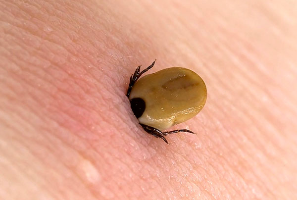 Infekcia po uhryznutí kliešťom