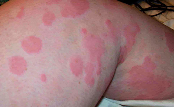 Alergia na uhryznutie kliešťom